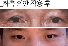좌측의안 착용 후