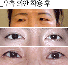 우측의안 착용 후